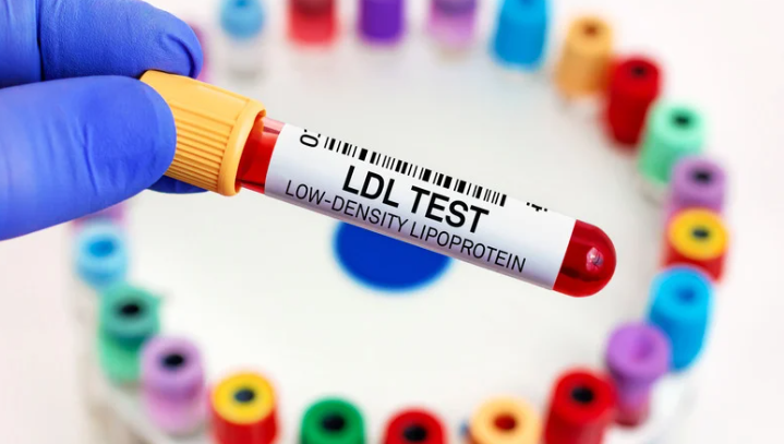 LDL cholesterol blood test illustrating understanding high cholesterol levels